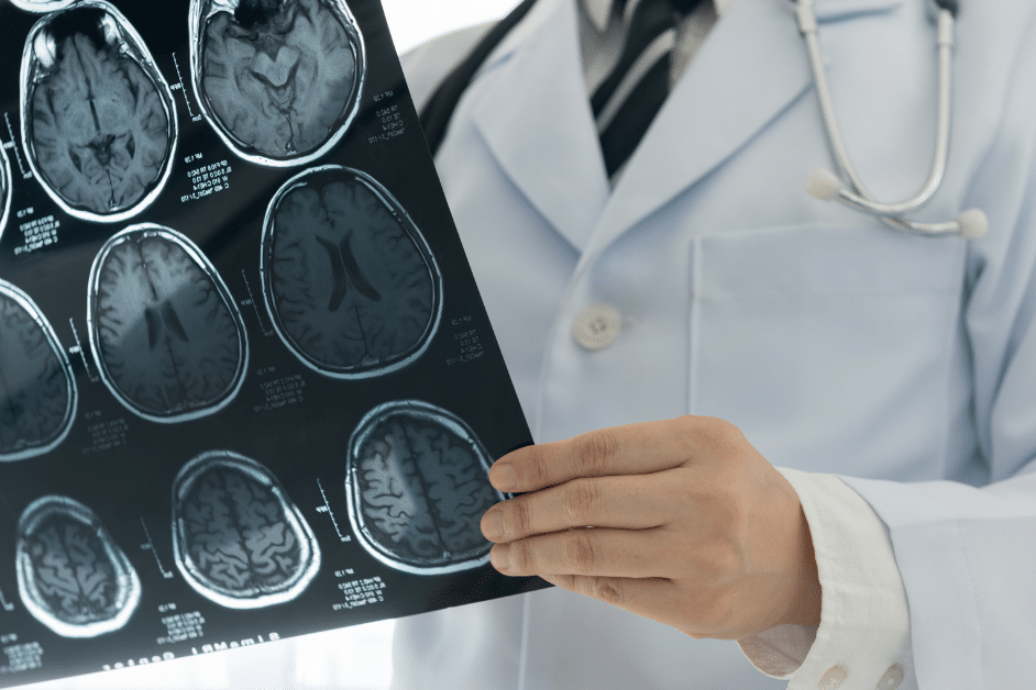 Are You Stroke Smart? Calculate Your Stroke Smart Score