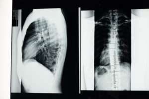 Spinal Cord Injury: Complications & Treatment | Dr. Chandril