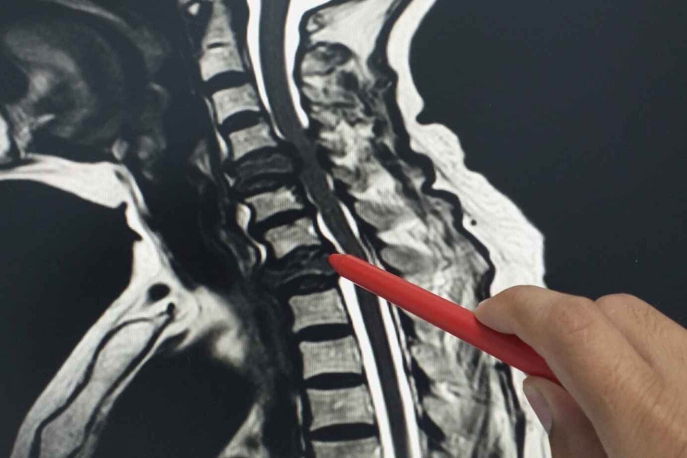 Spine surgery 5 Navigating the Complexity of Spine Surgery
