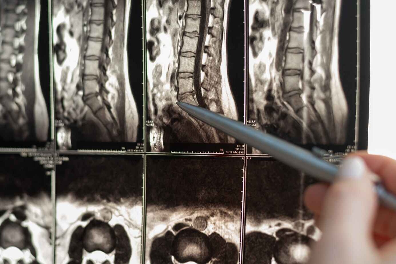 Types of Spine Surgery