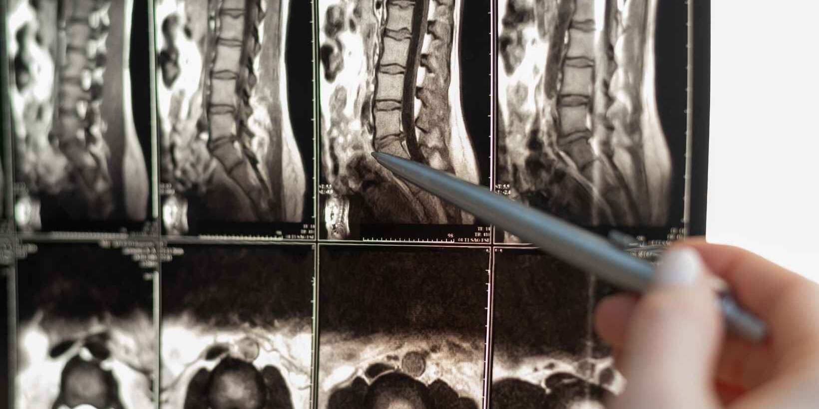 Types of Spine Surgery