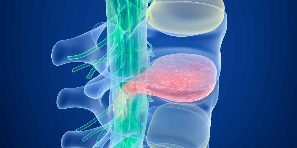 Spinal Fusion Surgery