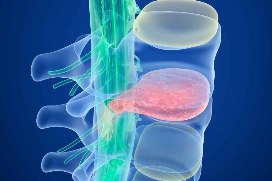 Spinal Fusion Surgery 4 Spinal Fusion Surgery