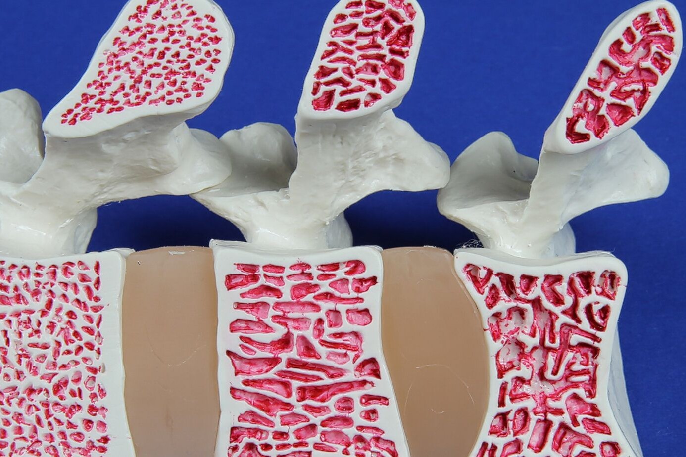 Brown-Sequard Spinal Cord Injury: What is Spinal Cord Injury? 7 Brown-Sequard Spinal Cord Injury