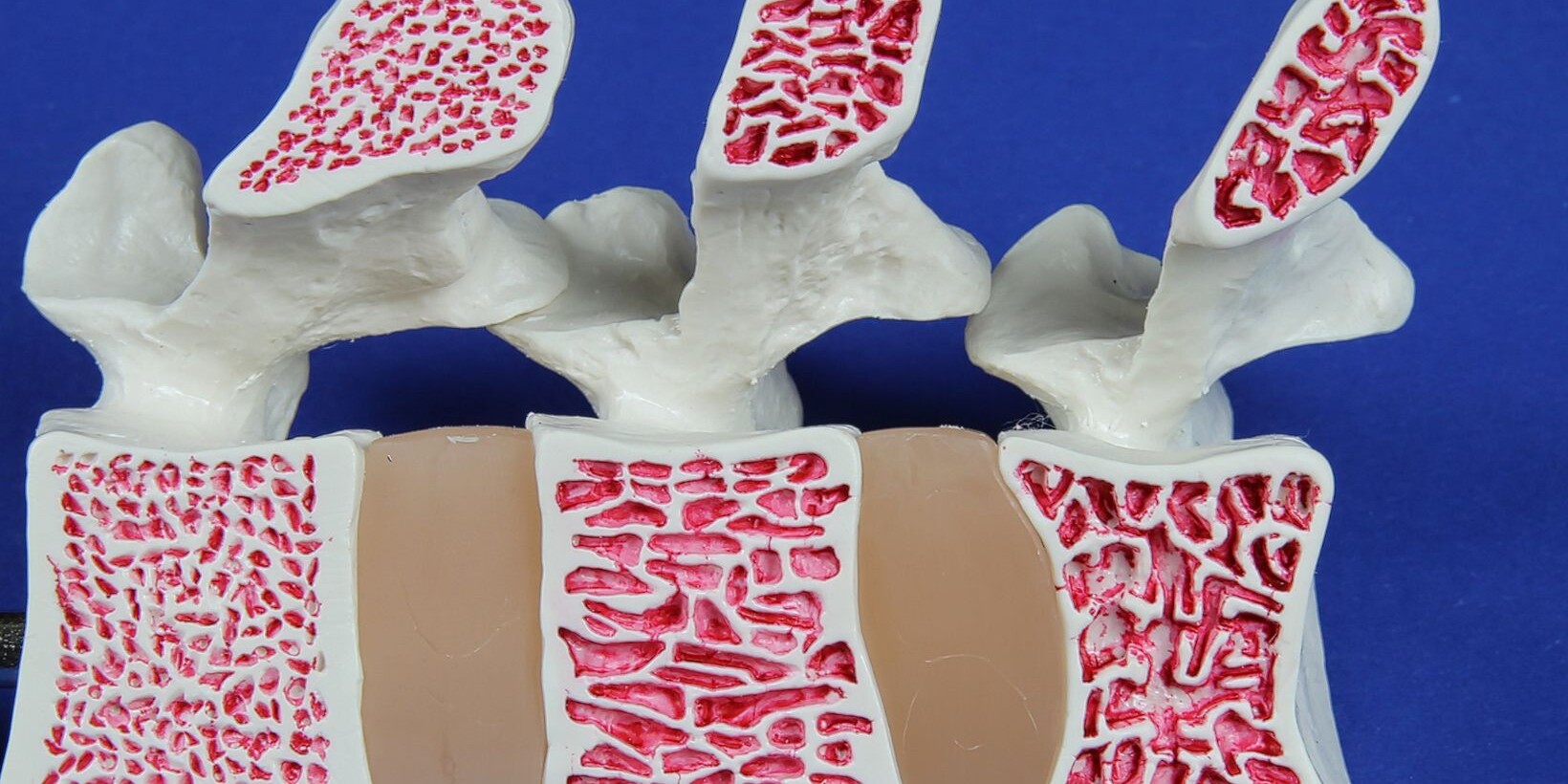 Brown-Sequard Spinal Cord Injury