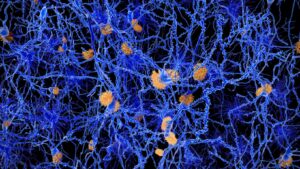 How Alzheimer's Disease Happens in the Brain