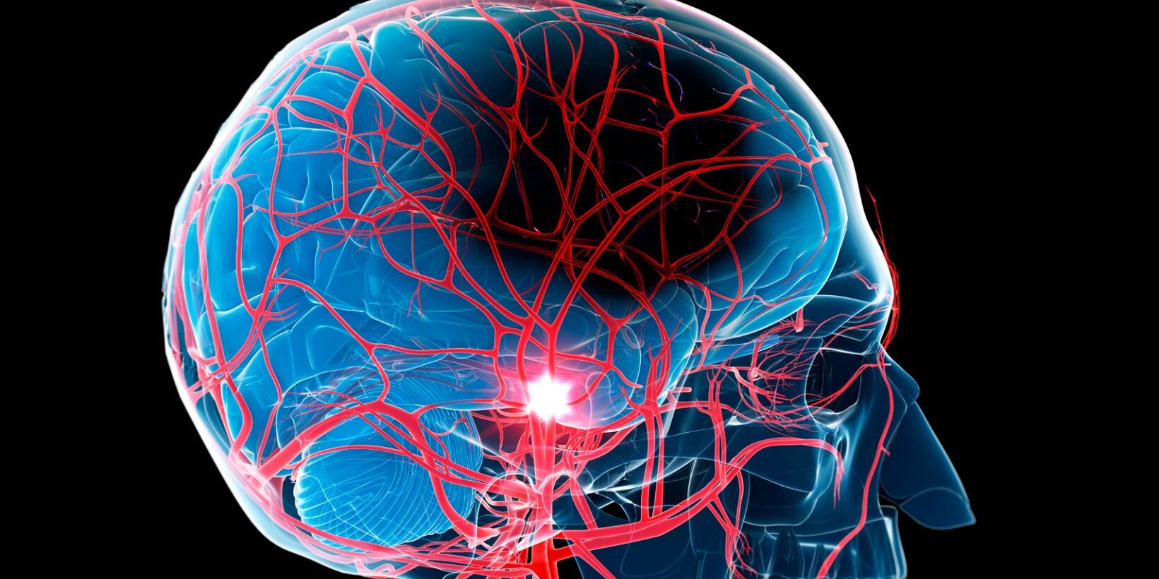 ischemic stroke management guidelines, Understanding Stroke A Simple Guide for Everyone