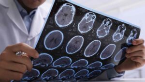 Understanding Thalamic Pain Syndrome: Key Facts You Should Know 2 amyotrophic lateral sclerosis diagnosis