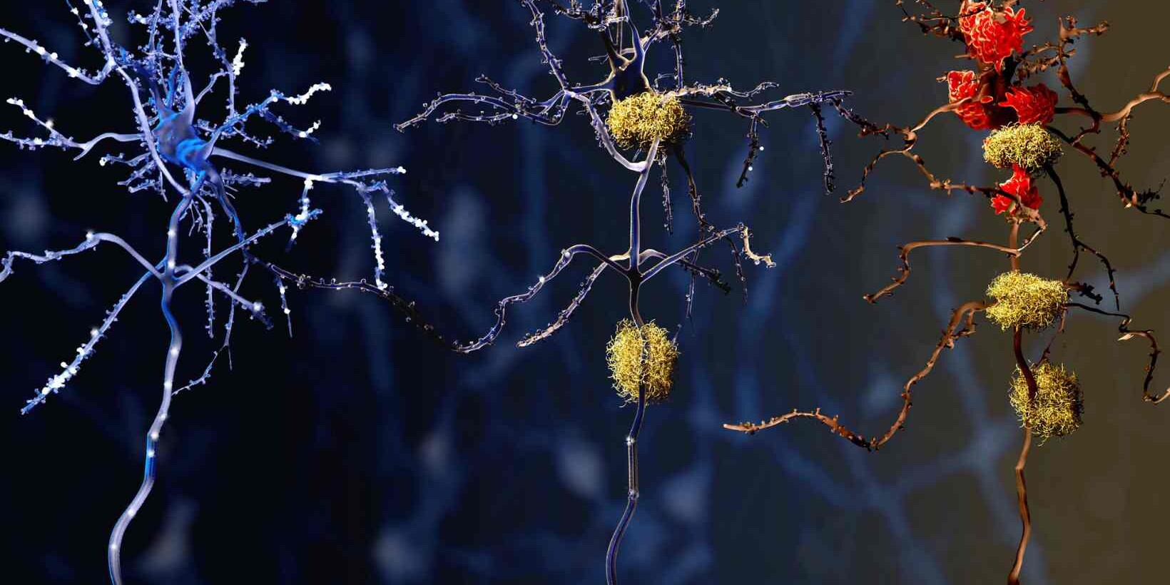 amyotrophic lateral sclerosis