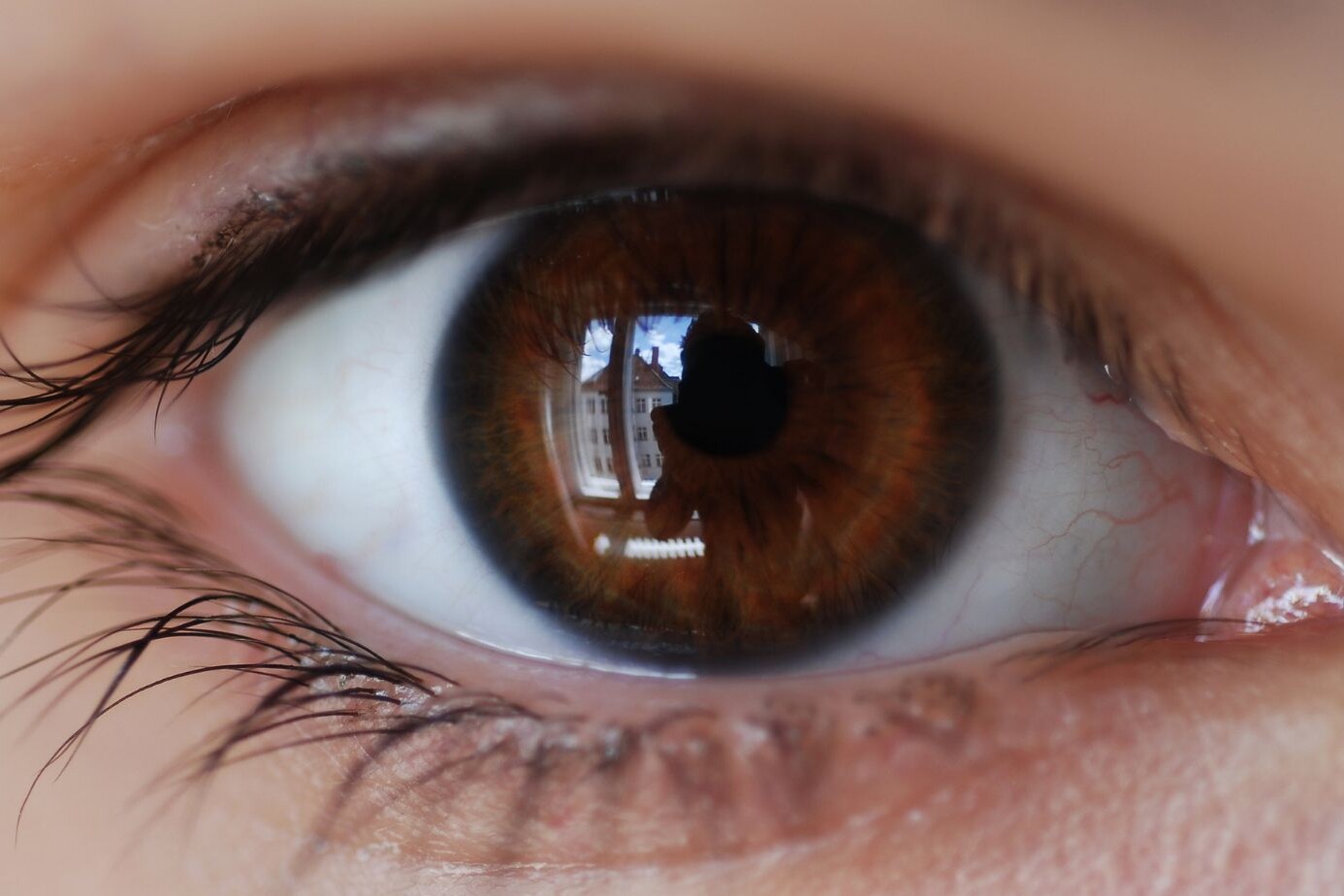 Understanding Benign Blepharospasm: Symptoms & Care 5 Understanding Benign Blepharospasm: Symptoms & Care