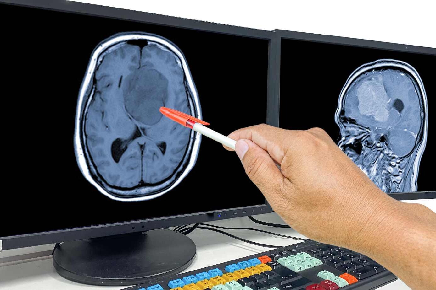 types of brain tumors