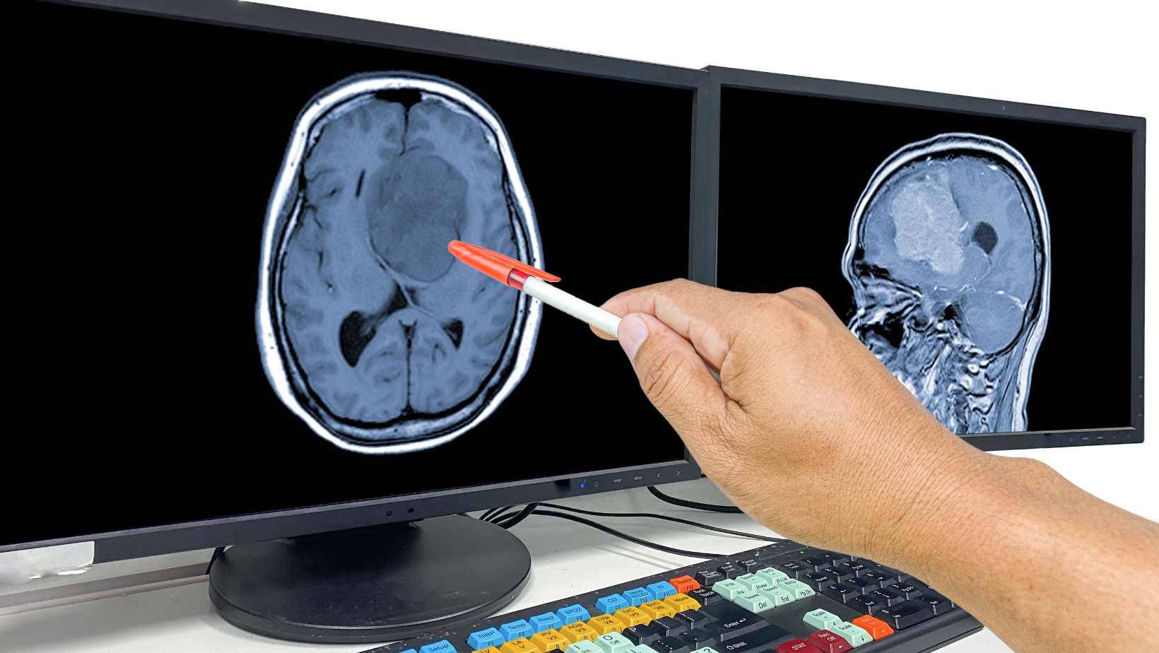 types of brain tumors