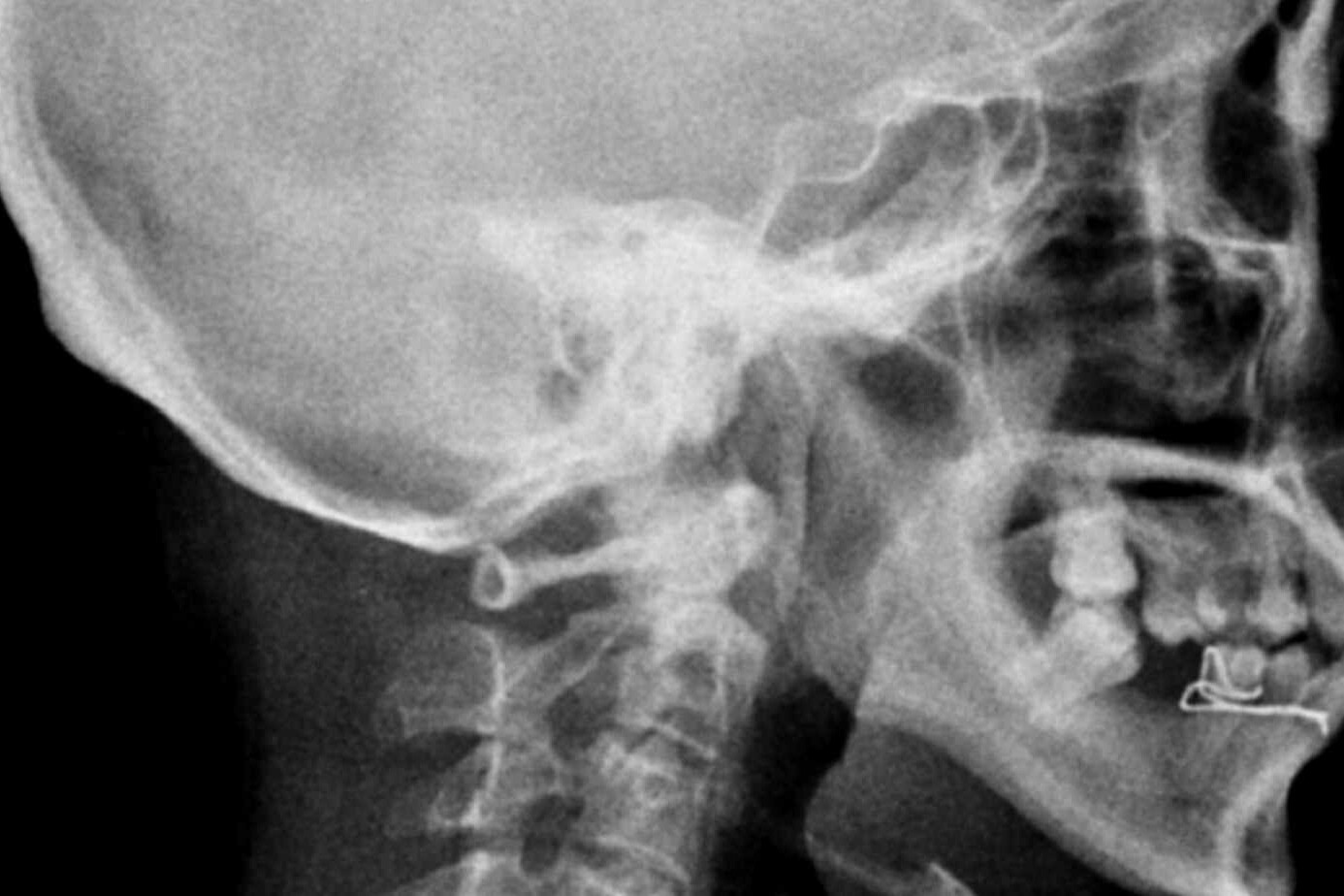 arnold chiari malformation radiology