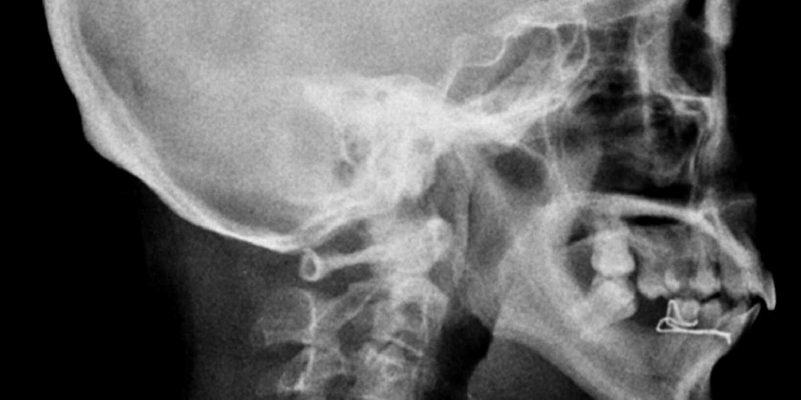 arnold chiari malformation radiology