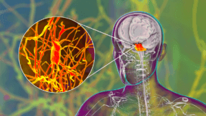 symptoms of cerebellar ataxia