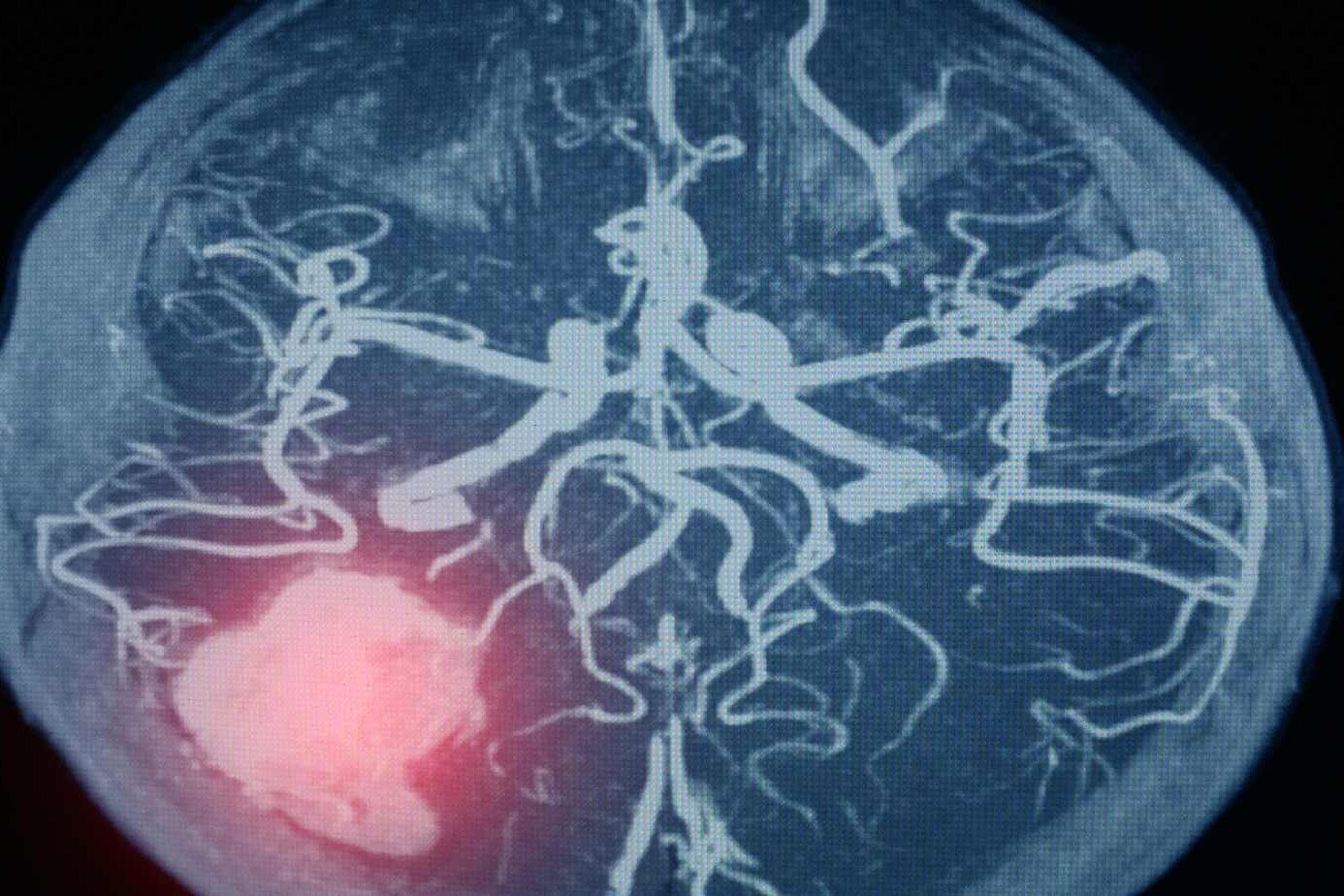 Aneurysmal Subarachnoid Hemorrhage (SAH)