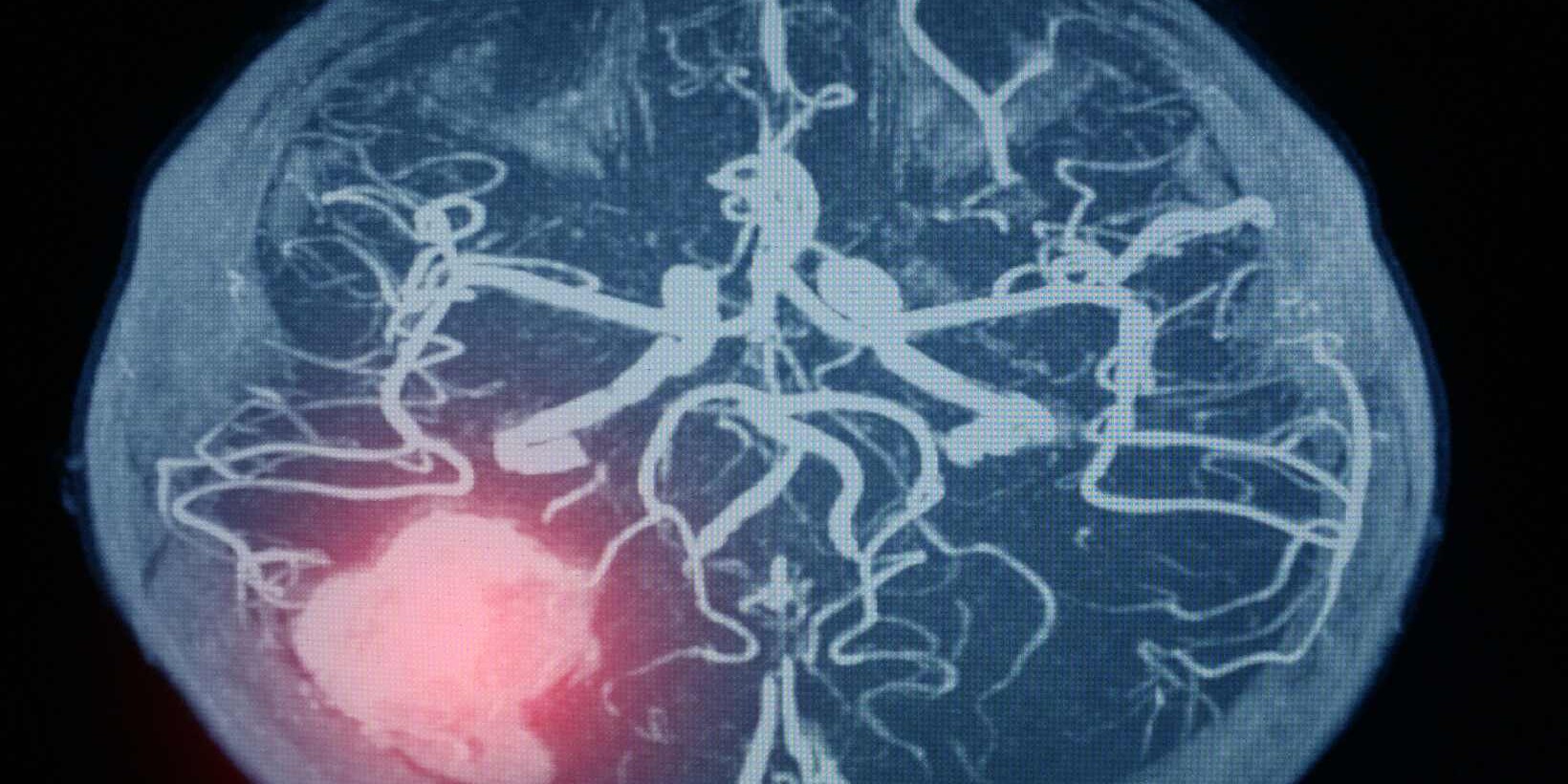 Aneurysmal Subarachnoid Hemorrhage (SAH)