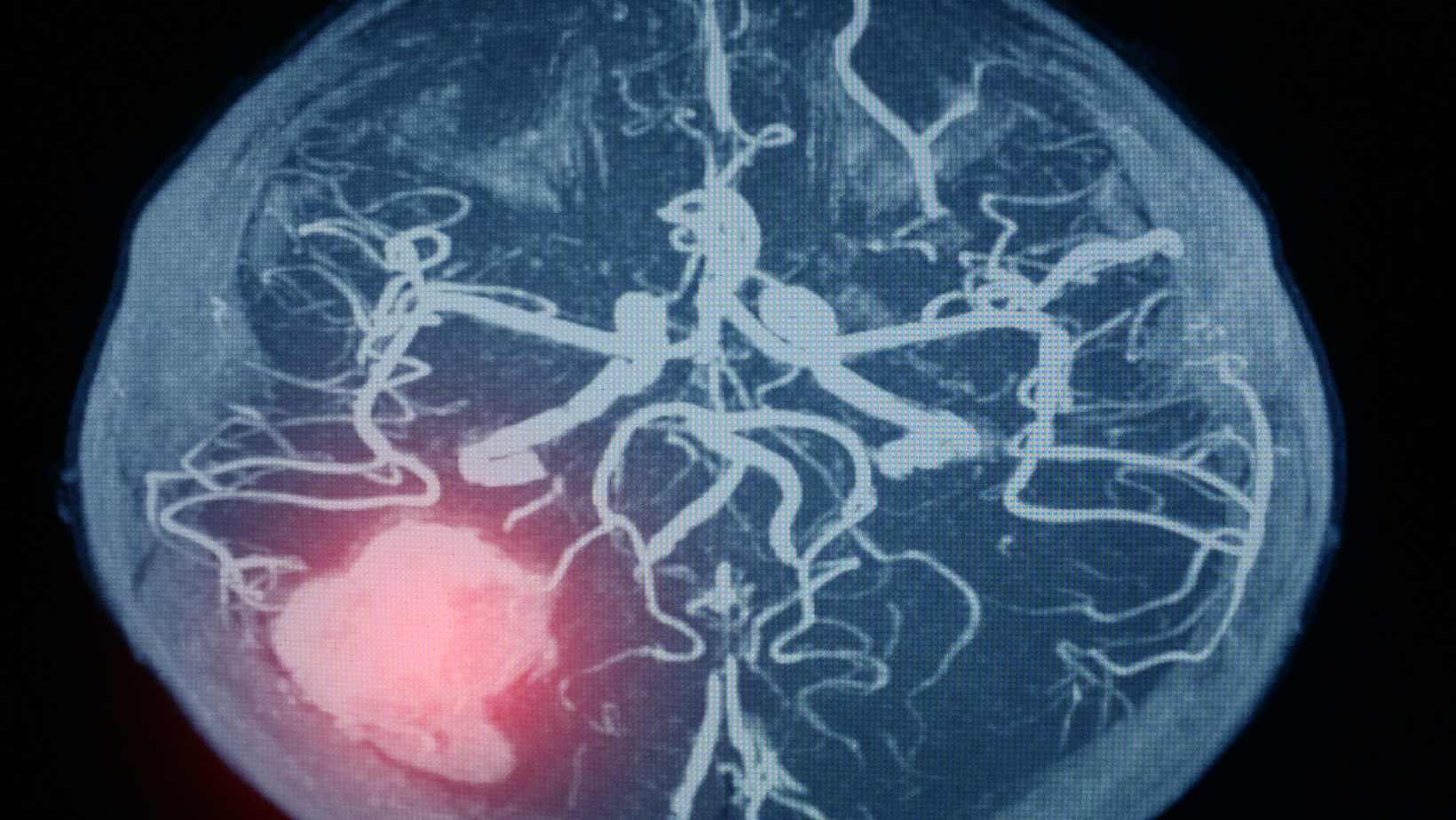 Aneurysmal Subarachnoid Hemorrhage (SAH)