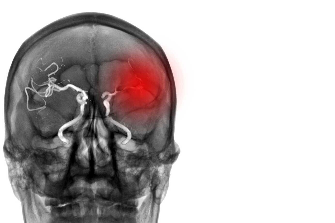 Causes of Ischemic Stroke: Risk Factors and Prevention 3 Causes of Ischemic Stroke: Risk Factors and Prevention