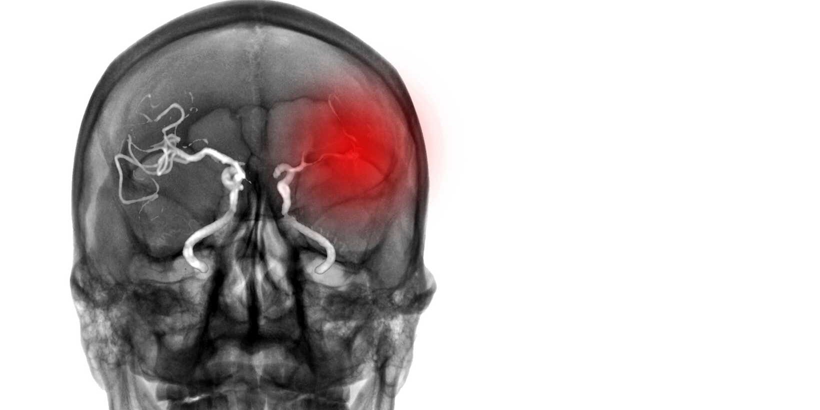 Causes of Ischemic Stroke: Risk Factors and Prevention