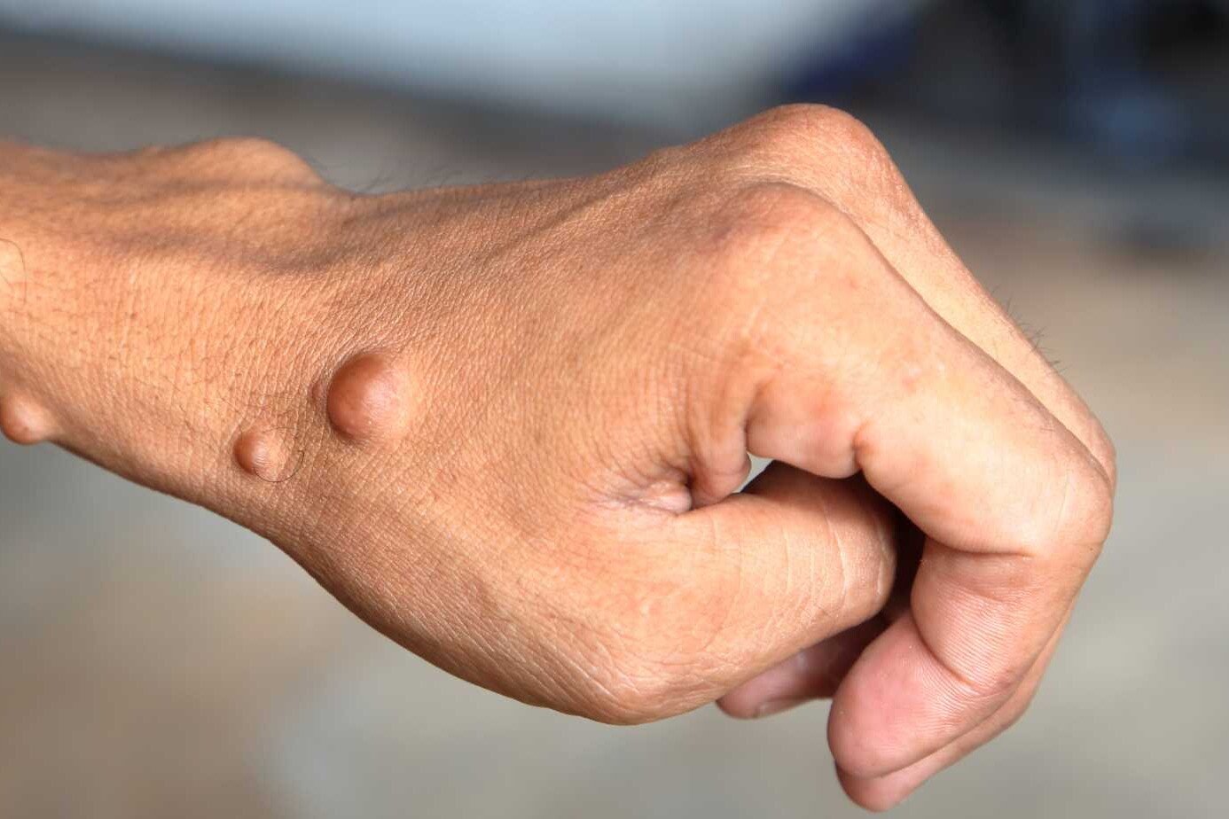 disease neurofibromatosis type