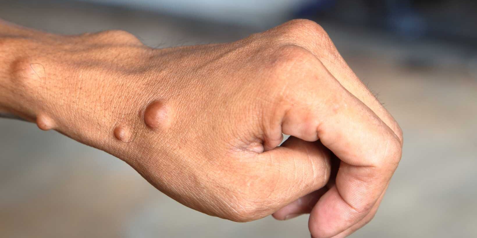 disease neurofibromatosis type