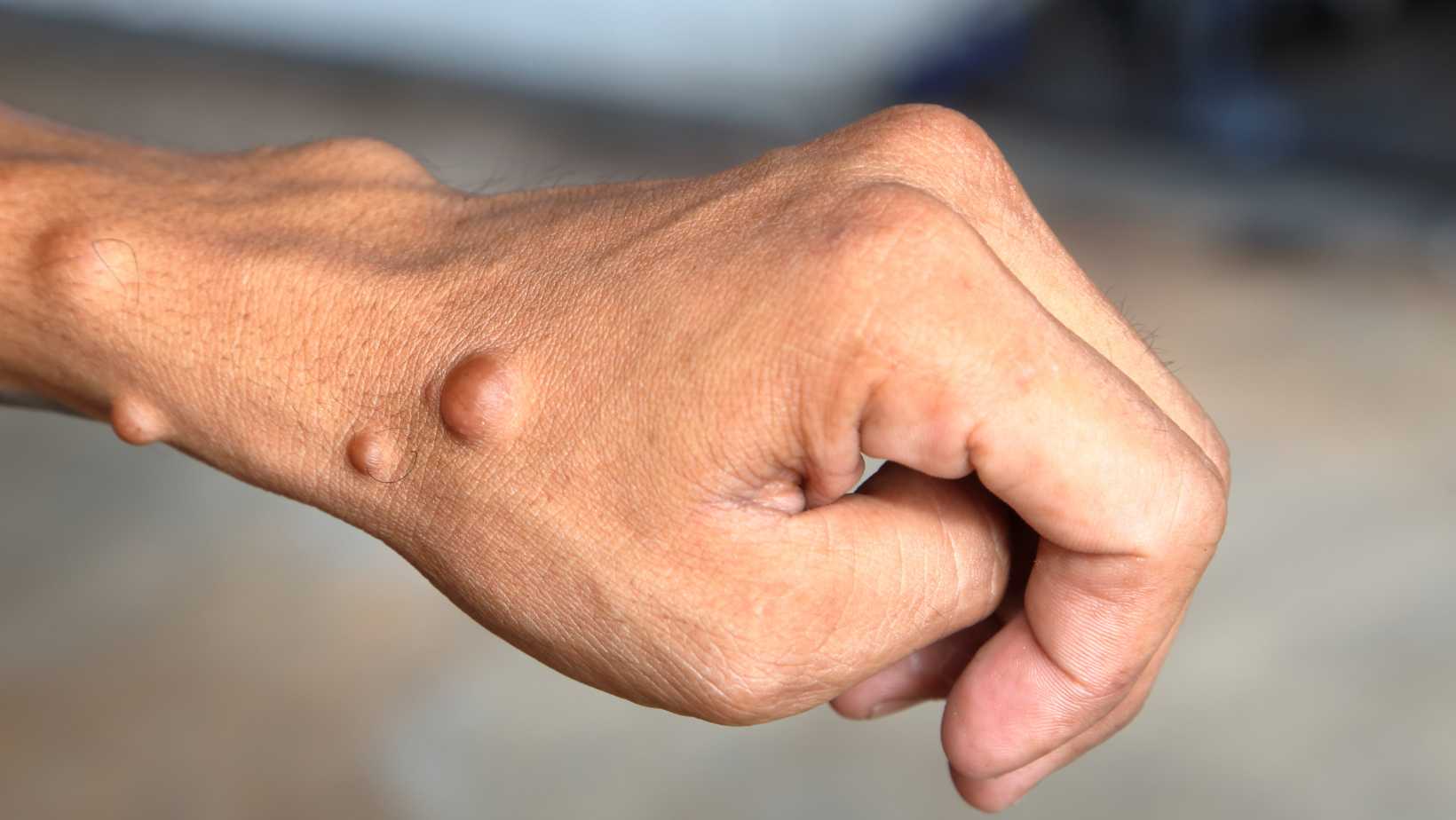 disease neurofibromatosis type