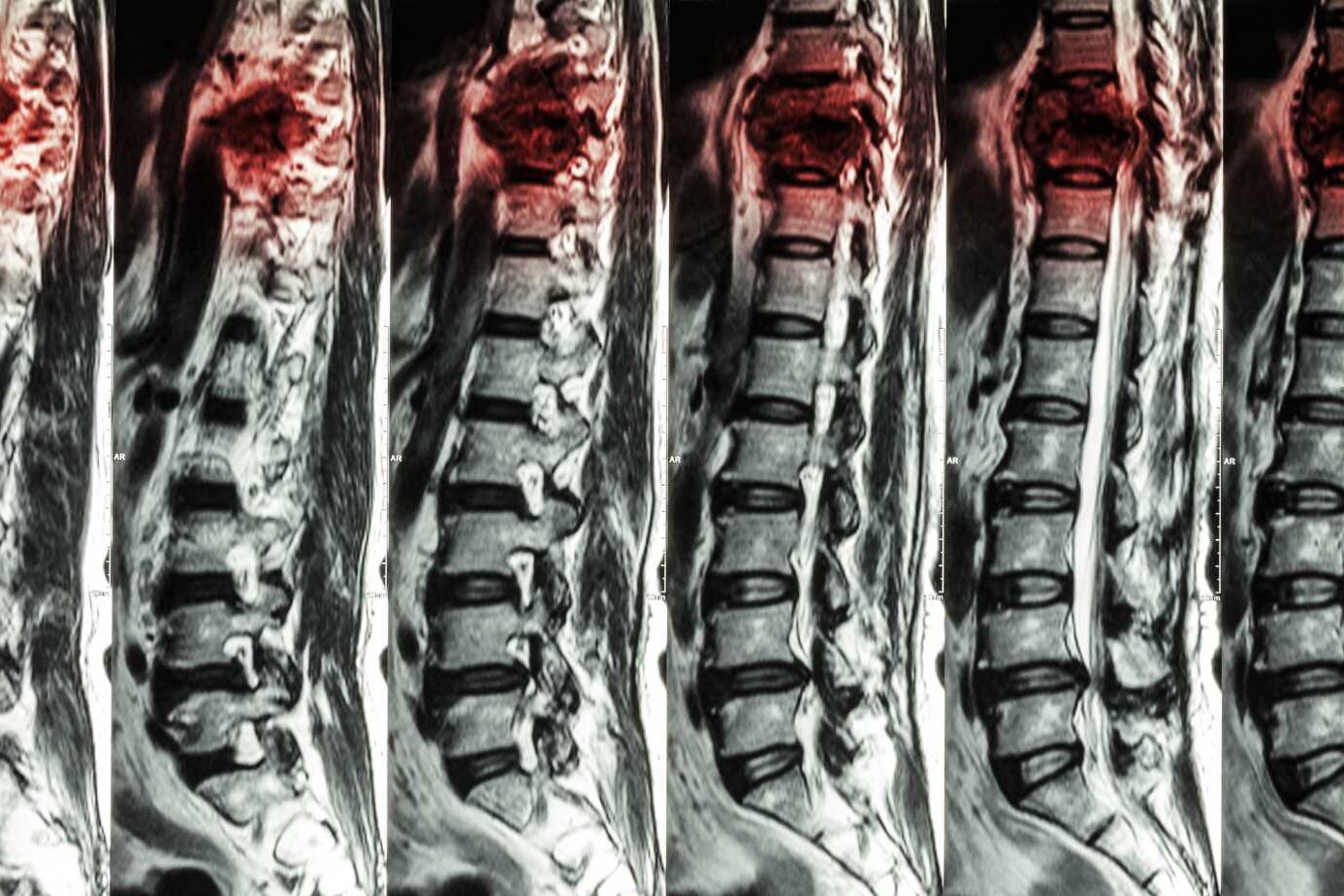 Understanding Compression of the Spinal Cord: Key Facts 3 compression of the spinal cord