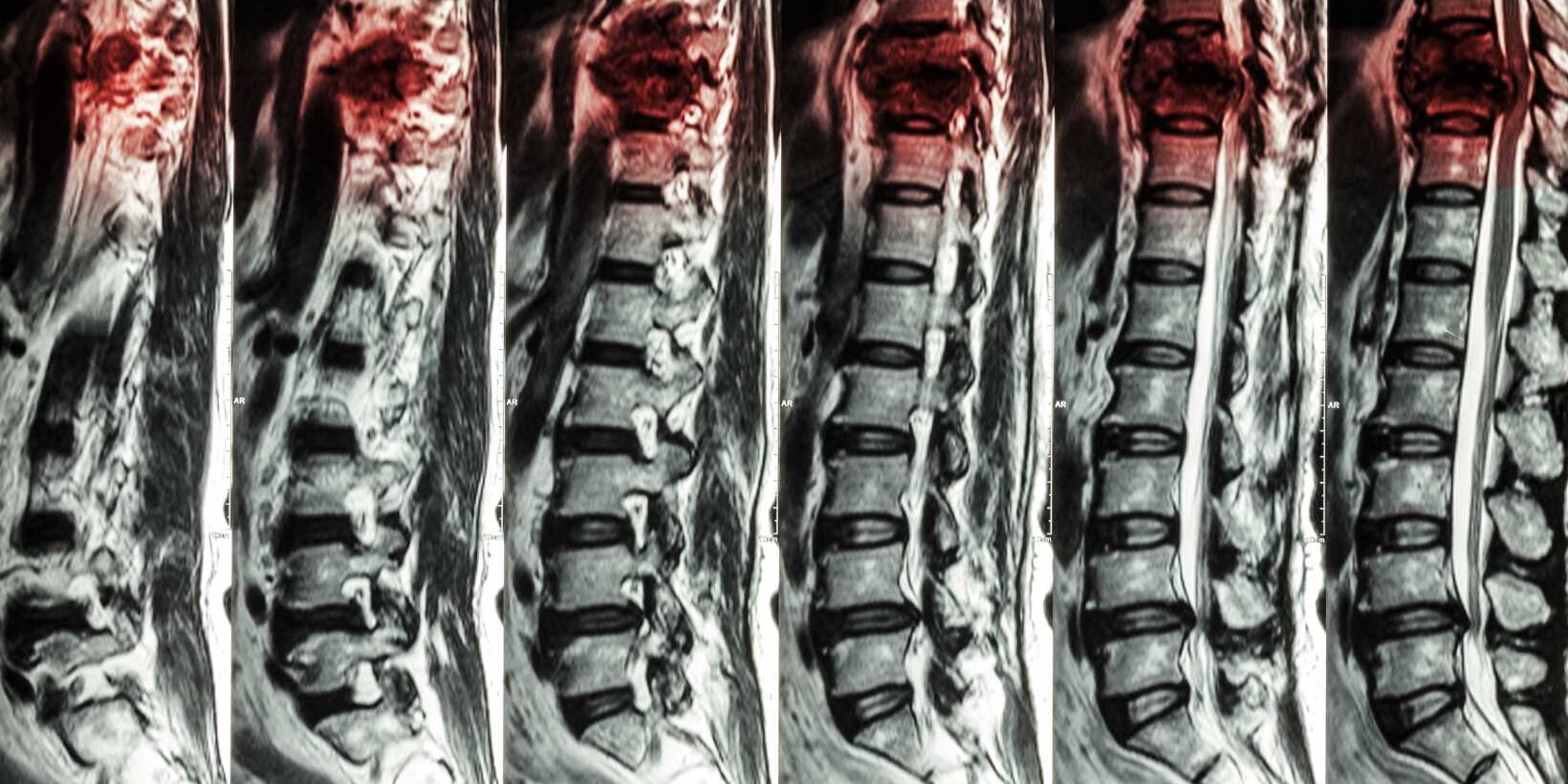 compression of the spinal cord