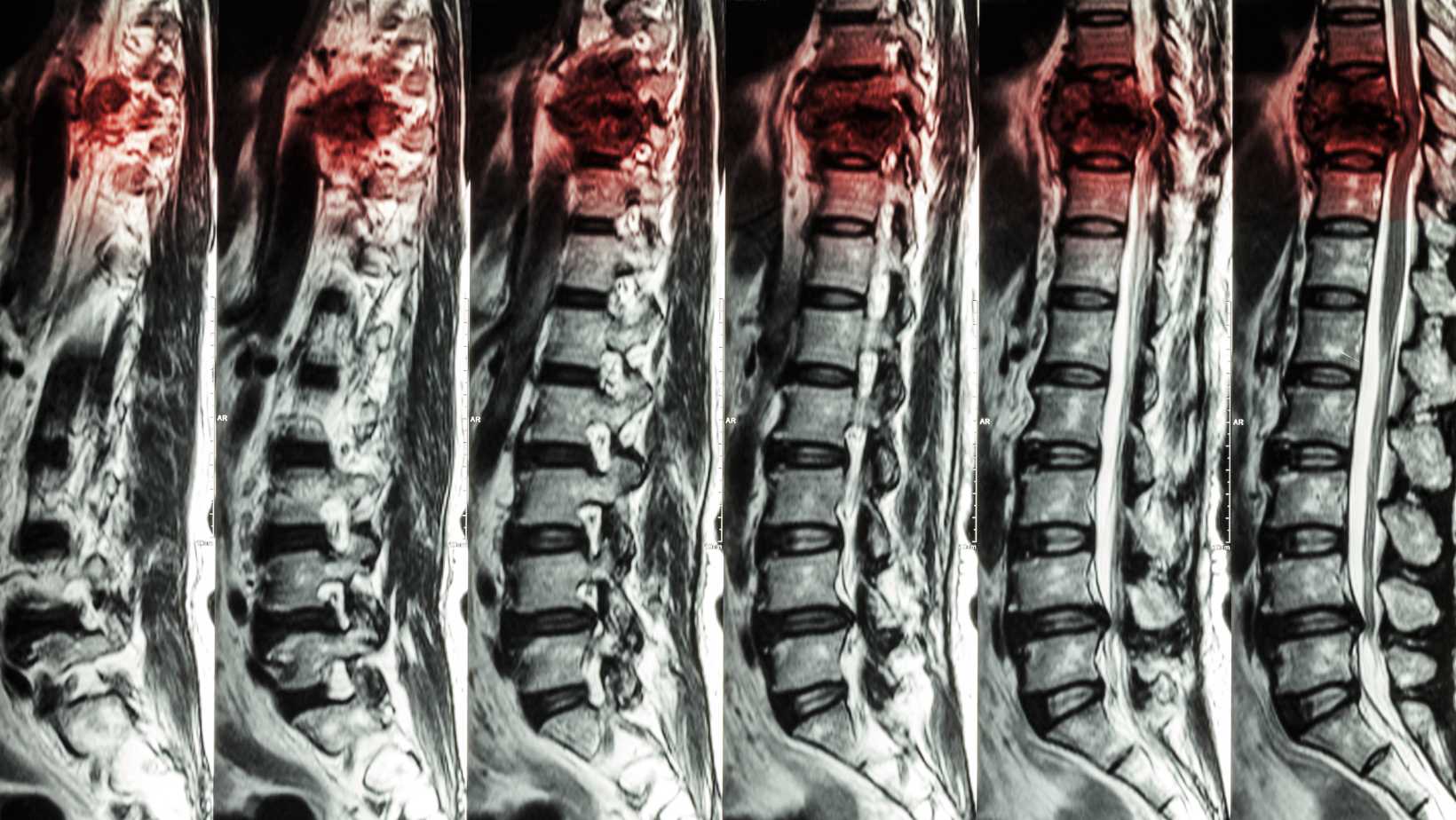 compression of the spinal cord