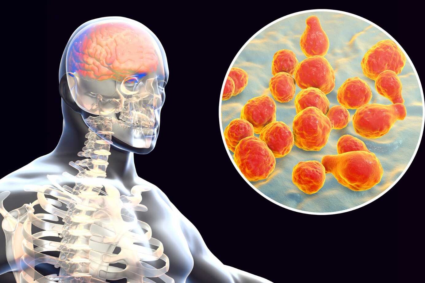 Surgical Management of Meningitis