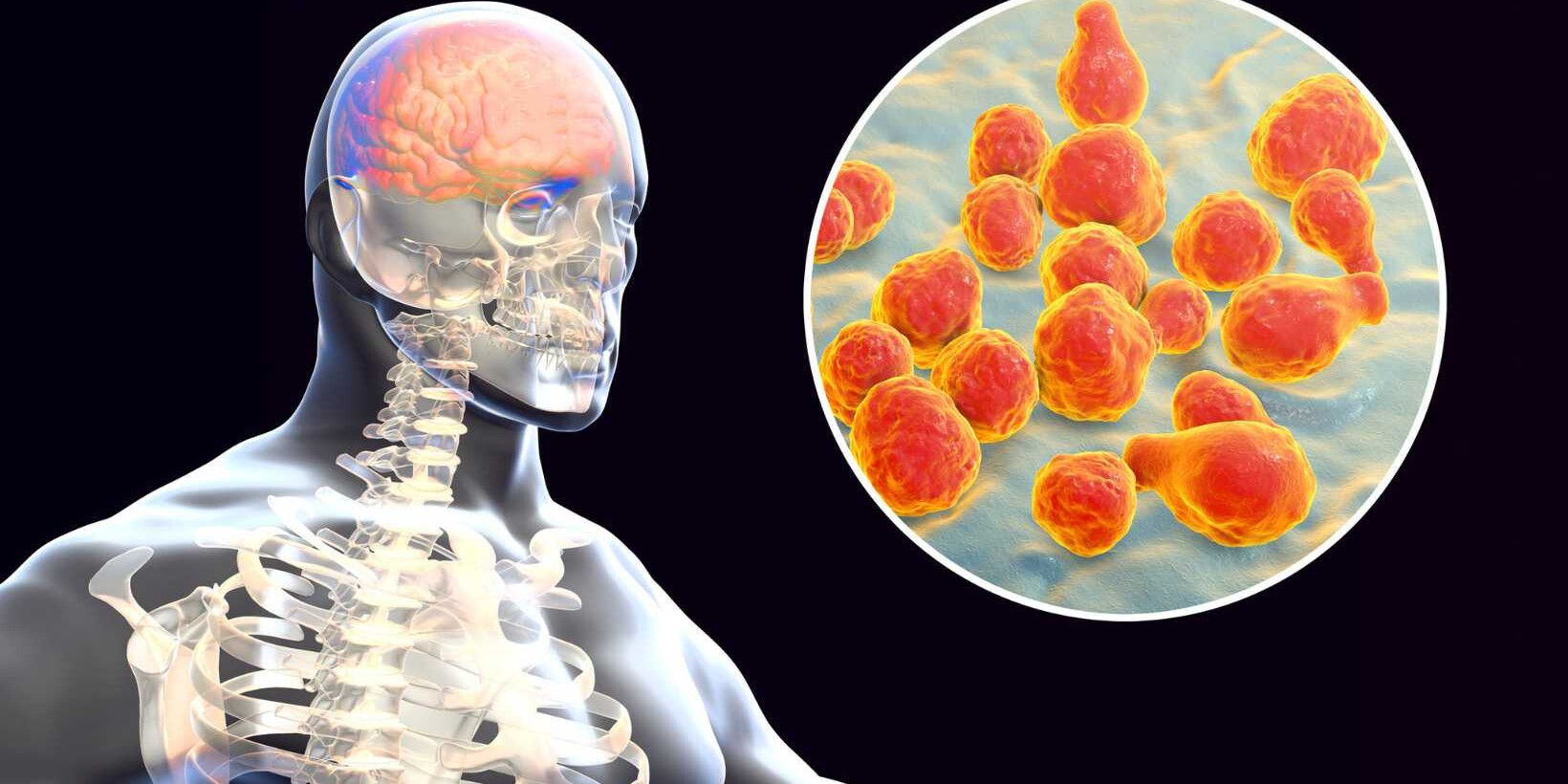 Surgical Management of Meningitis
