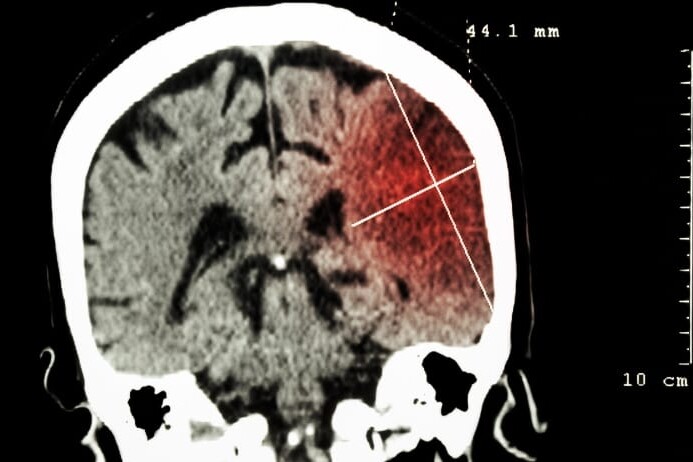 Transient Ischemic Attack (TIA) 4 Transient Ischemic Attack