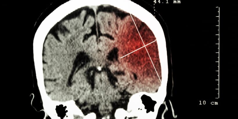 Transient Ischemic Attack