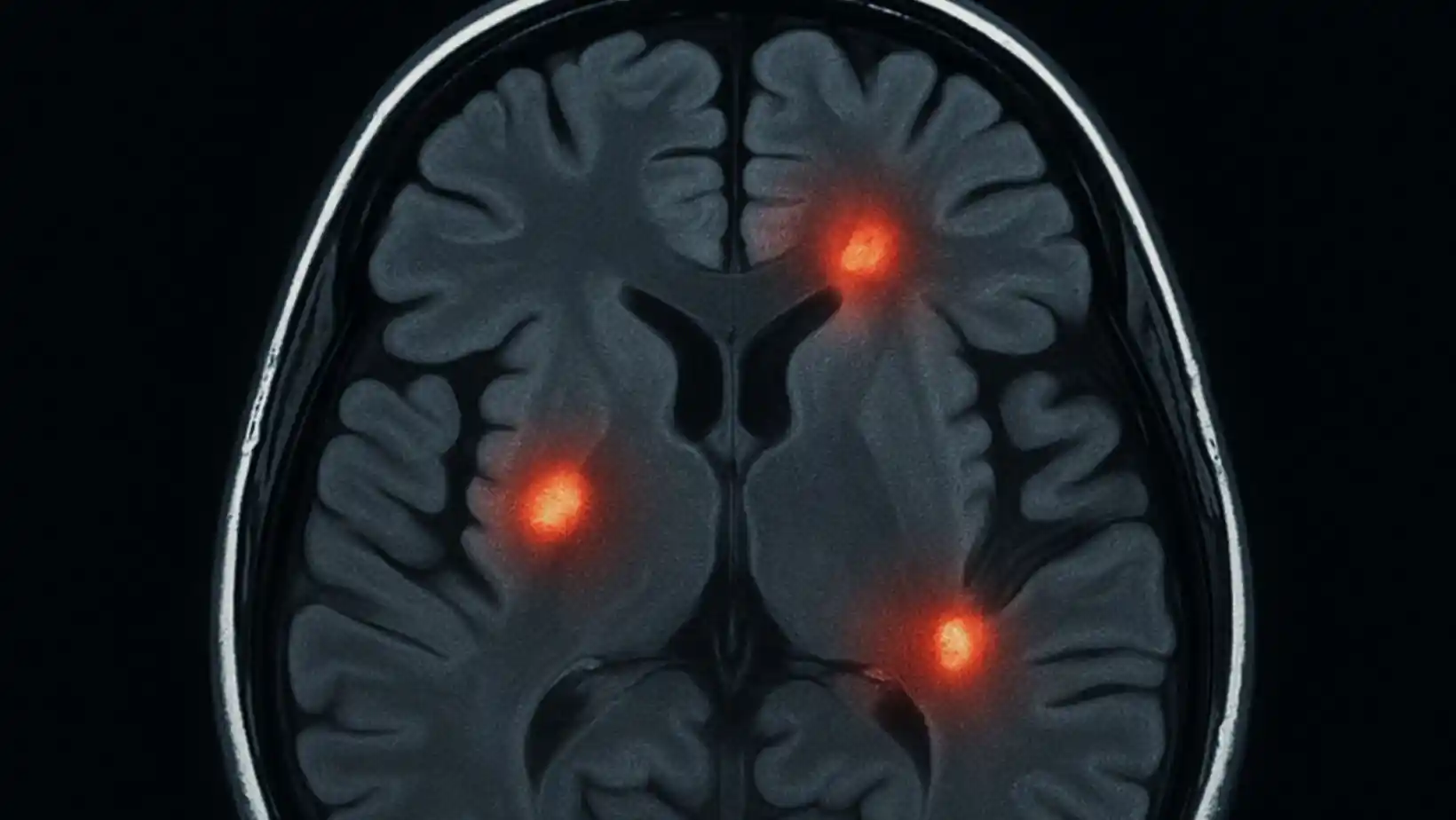 Acute Disseminated Encephalomyelitis (ADEM) 48 ADEM