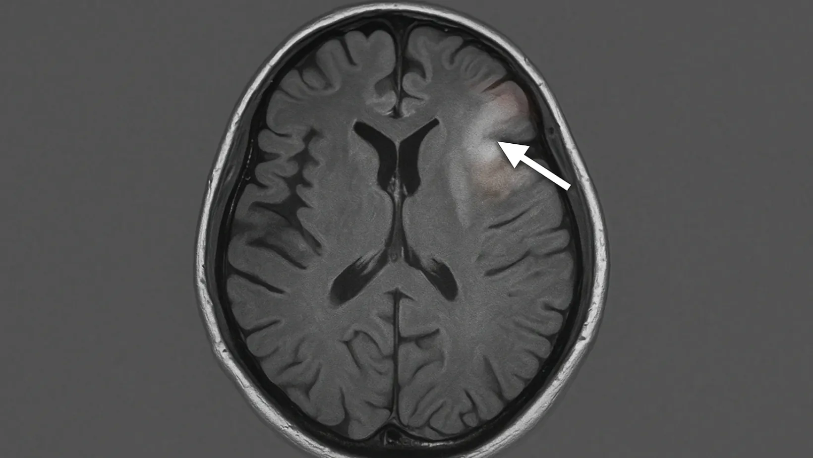Cerebral Edema (Brain Swelling) 47 cerebral edema