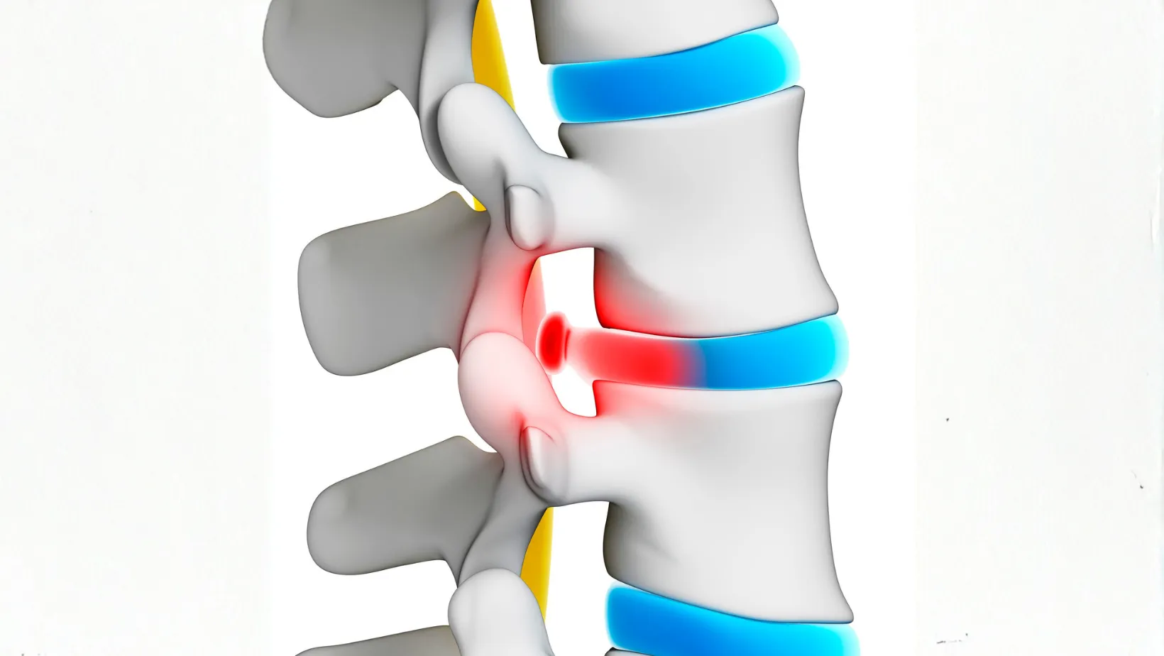 How to Heal a Bulging Disc Naturally: Treatments, Exercises & Recovery Tips 11 how to heal a bulging disc naturally
