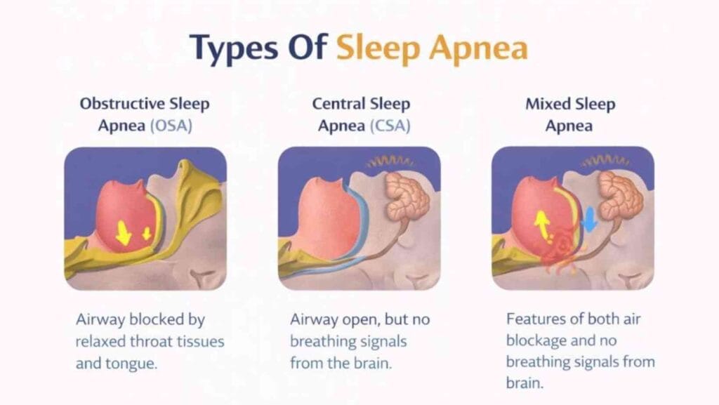  Types Of Sleep Apnea