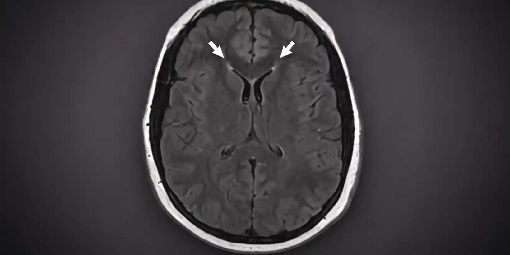 Cerebral edema