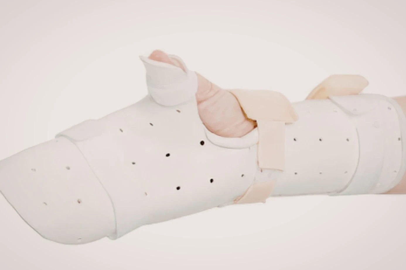 radial nerve palsy splint​