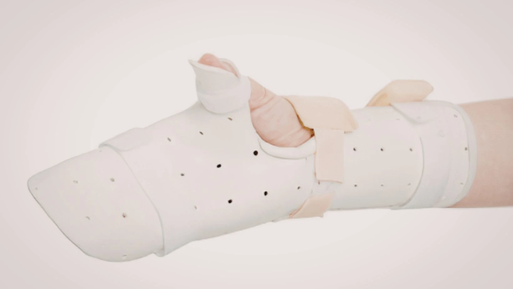 radial nerve palsy splint​